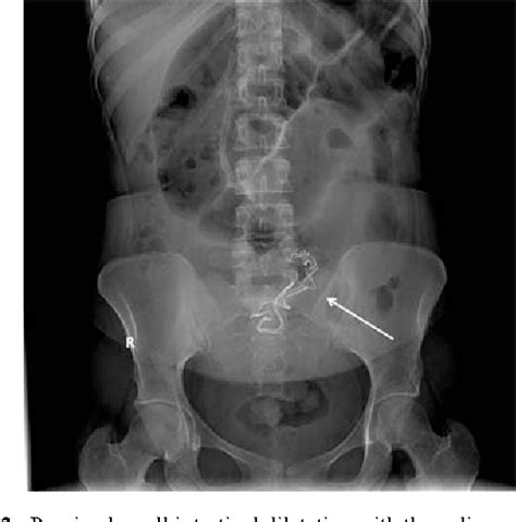 Figure 2 From Intraluminal Migration Of Retained Surgical Sponge As A