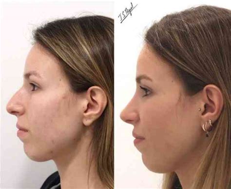 Rinoplastia Ultras Nica Eficiencia Y Diferencias Con La Cirug A