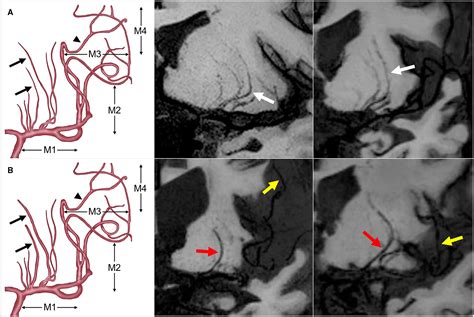 Association of Morphology of Lenticulostriate Arteries and Proximal ...