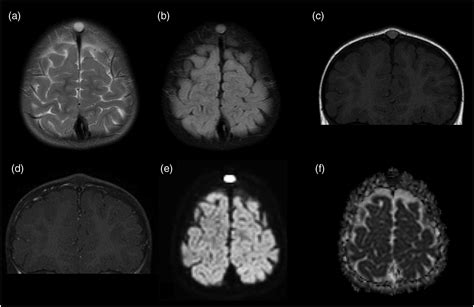 Dermoid Tumor Brain Mri