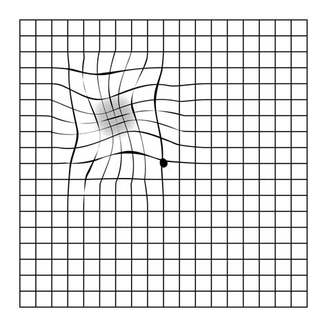 Amsler Grid Macular Degeneration Test At Home Lentiamo