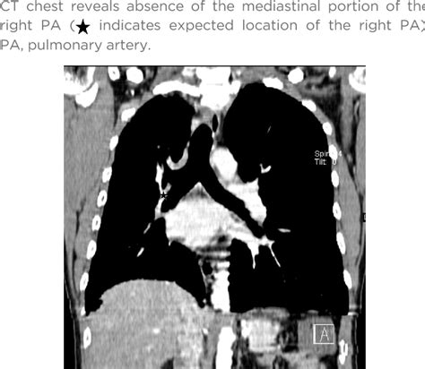 Figure From Imaging Diagnosis Of Isolated Proximal Interruption Of