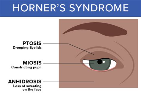 Horner’s Syndrome: Causes, Symptoms, Treatments