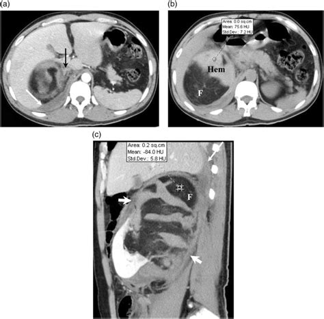 Case 4 A Contrast Enhanced Ct Scan At The Level Of The Adrenal Gland