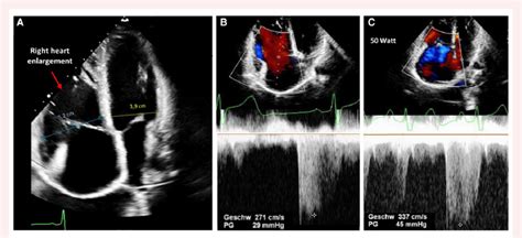 Transthoracic Echocardiography Pre Atrial Septal Defect Closure