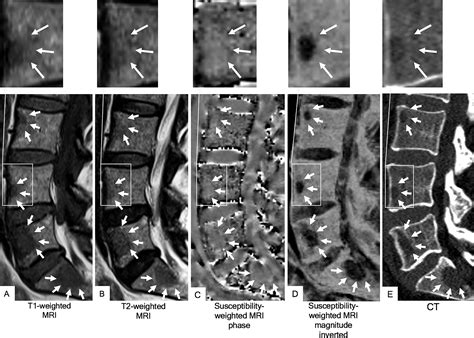 Differentiation Of Predominantly Osteoblastic And Osteolytic Spine