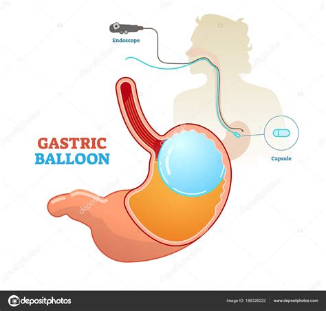 Gastric Balloon