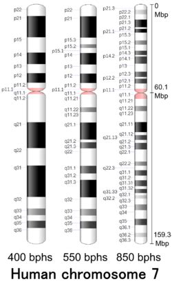 Recognizing Williams Beuren Syndrome In Diverse Populations