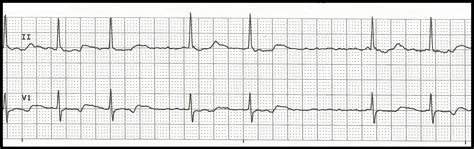 Atrial Fibrillation Pacemaker For Atrial Fibrillation