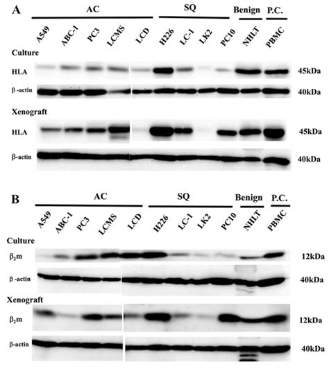 Downregulated Expression Of Human Leukocyte Antigen Class I Heavy Chain