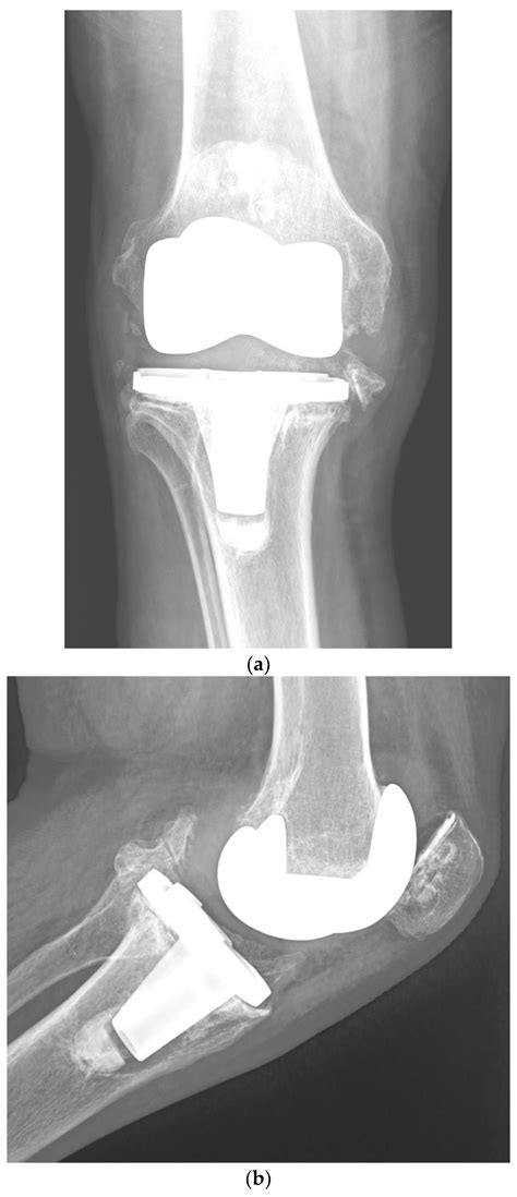 Risk Factors For Pji Following Primary Tka Encyclopedia Mdpi