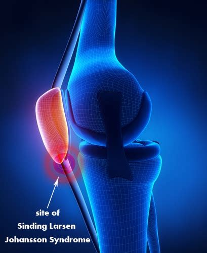 Sinding Larsen Johansson Syndrome Physiopedia