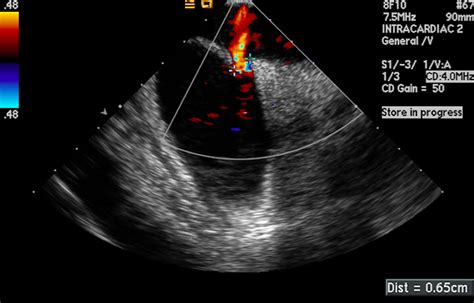 Patent Foramen Ovale Closure For Stroke Prevention And Other Disorders