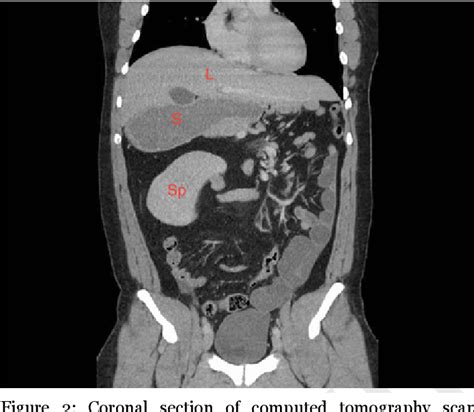 Figure 1 From Small Bowel Obstruction In An Adult Patient With Situs Ambiguous And Mid Gut