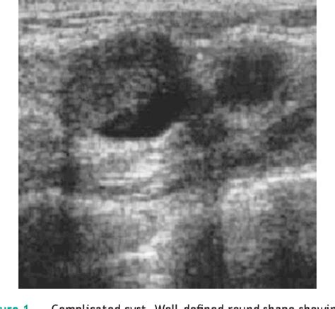 Table 1 From Complex Cystic Breast Masses In Ultrasound Examination