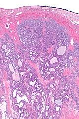 Ovarian Microcystic Stromal Tumour Libre Pathology