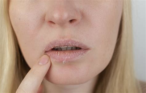 7 Effective Ways To Cure Chapped Lips Effectively