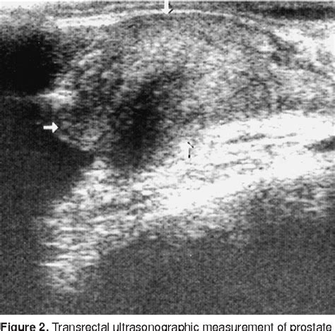 Figure From Analysis Of Suprapubic And Transrectal Measurements In