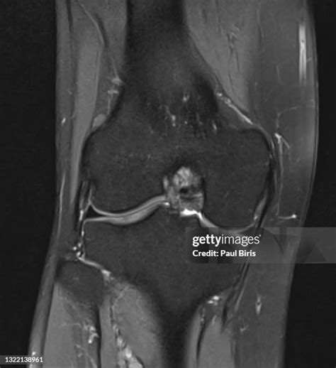 61 Anatomical View Of Knee Ligaments Stock Photos High Res Pictures