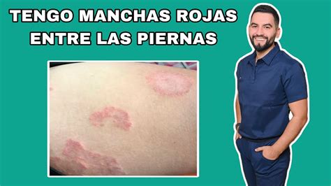 Tengo Manchas Rojas En La Ingle Que Pican Tiña Inguinal Dr David Campos Youtube