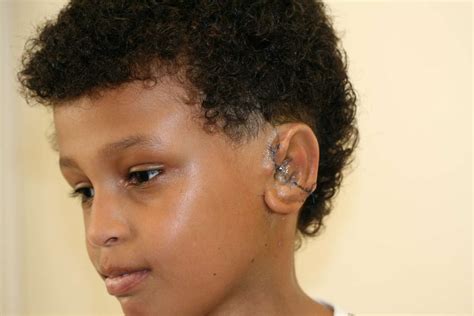 Cup Ear, Microtia & Anotia - Ear Reconstruction for missing or small ears