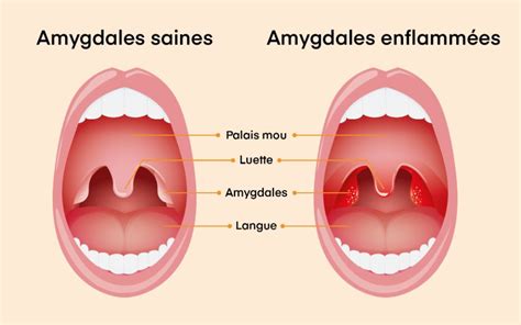 Amygdalite Traitement Maison Home Alqu