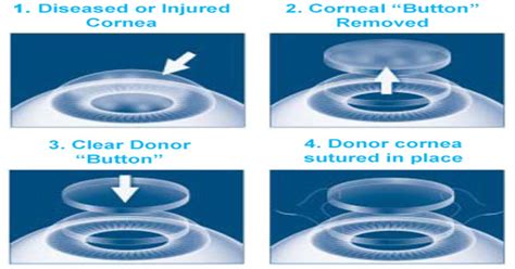 Cornea Transplant Cost | Best Cornea Specialist In Mumbai | Keratoplasty