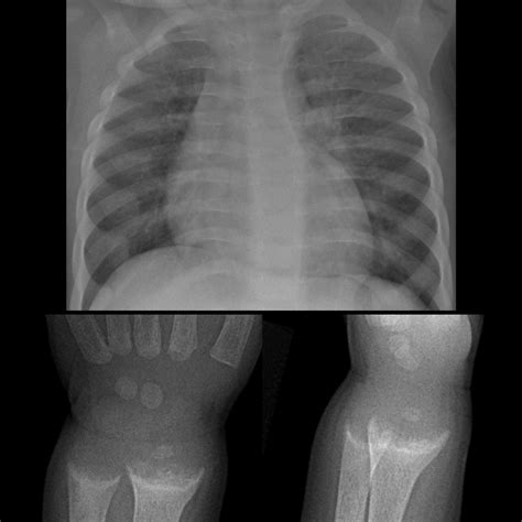 Vitamin D Deficiency Rickets | Pediatric Radiology Reference Article ...