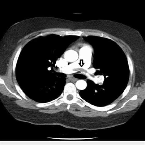 Ct Pulmonary Angiogram Showing Saddle Embolus In The Main Pulmonary