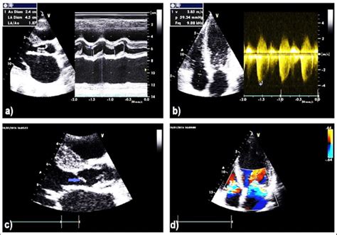 Transthoracic Echocardiography Tte Images Show A M Mode Revealing