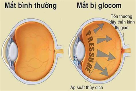 Glaucoma Gl C M C M N C T Ng Nh N P L B Nh G T I Sao L I