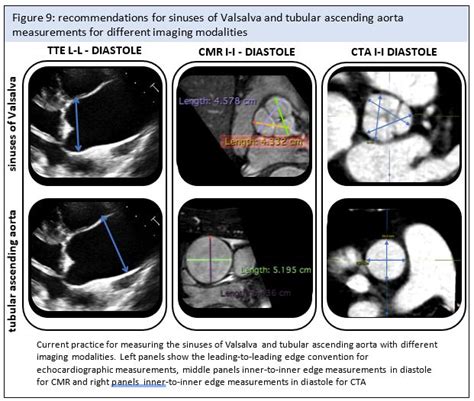 How To Measure The Aorta In The Setting Of Genetic Aortic Disease