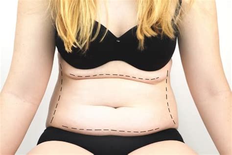 Quel résultat après une abdominoplastie Chirurgien esthétique Lyon