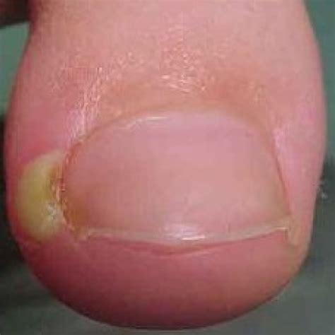 Ingrown Toenails Barrhaven Foot Care Orthotics Ottawa S Foot Care