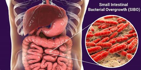 The 8 Effective Natural Remedies for Managing SIBO Symptoms!