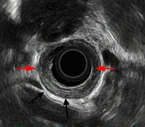 Eosinophilic Esophagitis – Endoscopy Campus