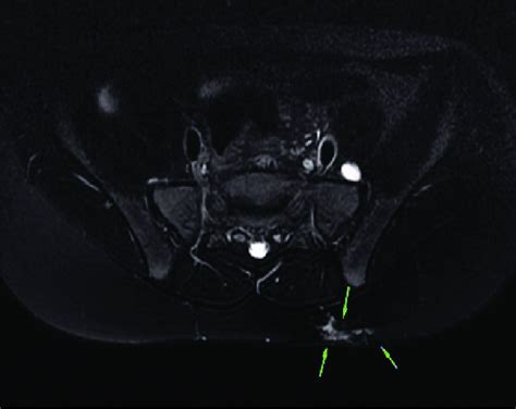 An MRI of the lumbar-sacral region, T1-weighted image. The area of ...