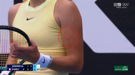 Tennis Prodigy Mirra Andreeva Leaves Bite Mark On Arm In Intense