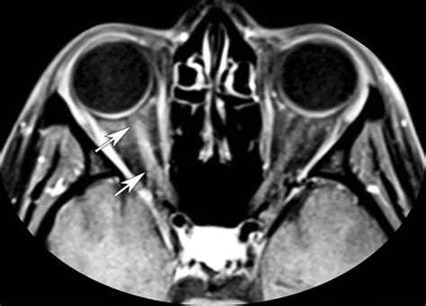 Neuromyelitis Optica Spectrum Disorders Spectrum Of Mr Imaging Findings And Their Differential