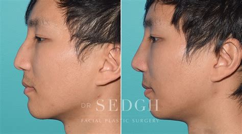 Asian Rhinoplasty Before And After Photos Dr Sedgh