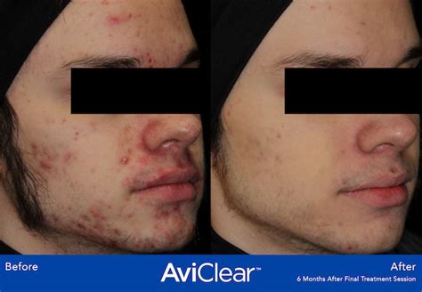 Laser Acne Treatment With AviClear Quinn Clinics Bristol