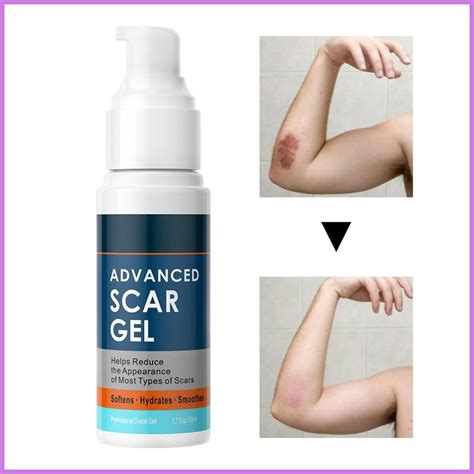 Burn Scar Removal Lightweight Repairing Scar Cream Scar Removal Gel ...