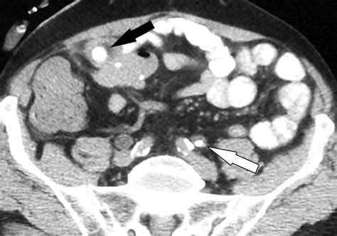 CT Findings In Urinary Diversion After Radical Cystectomy Postsurgical