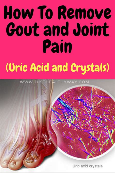 Gout Is An Arthritis Type Caused By The Accumulation Of Uric Acid In