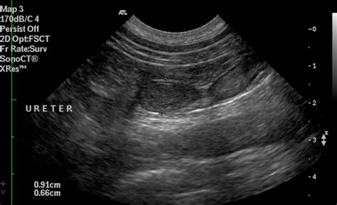 Transitional Cell Carcinoma Ultrasound