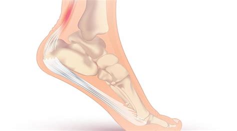 Achilles injury: Causes, symptoms and treatment | Health News - The ...