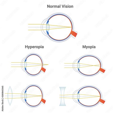 Myopia Hyperopia And Normal Vision Common Vision Disorders Short