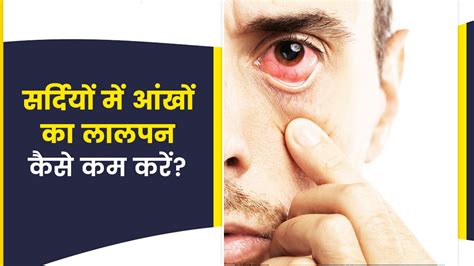 सर्दी में आंखें लाल क्यों हो जाती हैं जानें इसे दूर करने के उपाय How To Cure Eye Redness In