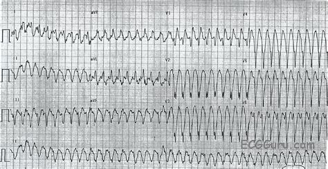 Wide Complex Tachycardia Ventricular Tachycardia Ecg Guru