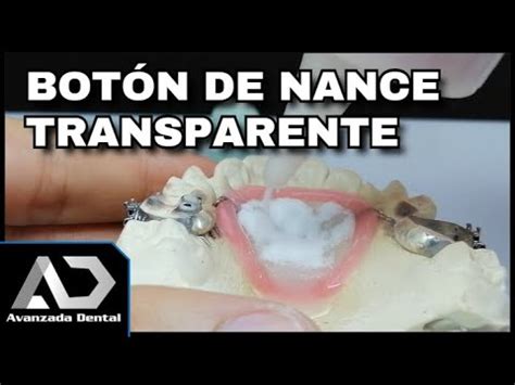 Como Acrilar N De Nance Transparente Ortodoncia Youtube